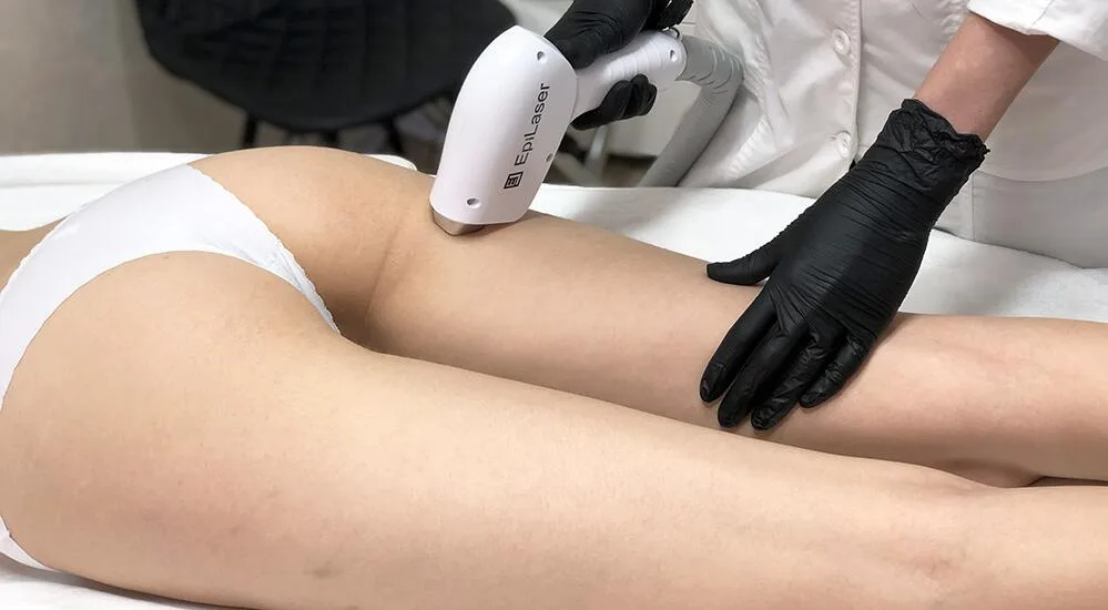 В Івано-Франківську лазерна епіляція стала стандартом догляду